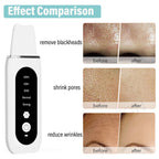 Ultrasonic Skin Scrubber — Deep Pore Cleansing & Peeling Device